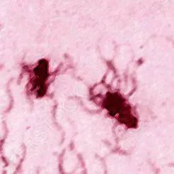 chat with ai character: TYPHOID FEVER-1